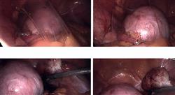 posgrado master endometriosis