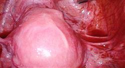 curso online experto evaluacion clinica diagnostico endometriosis