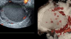 posgrado experto evaluacion clinica diagnostico endometriosis
