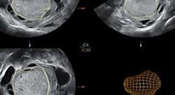 curso online experto tratamientos fertilidad endometriosis