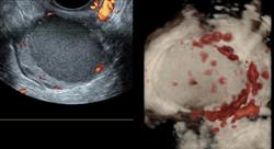 posgrado experto tratamientos fertilidad endometriosis