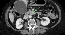 diplomado cirugía de vía biliar