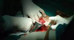 curso online cirugía pancreática