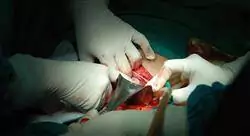 curso cirugía del colon