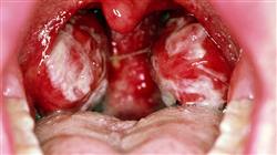 master online infectologia clinica antibioticoterapia