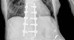 diplomado online cirugía ortopédica y traumatología de la columna vertebral