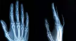 diplomado online cirugía ortopédica y traumatología de mano y antebrazo