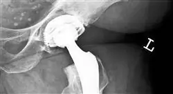 diplomado online cirugía ortopédica y traumatología de pelvis cadera y fémur