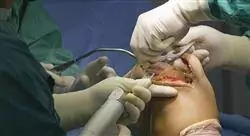 diplomado online cirugía ortopédica y traumatología de rodilla