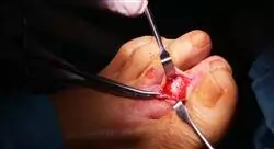 diplomado online cirugía ortopédica y traumatología de pie y tobillo