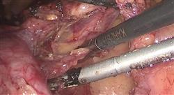 especializacion nuevas técnicas de cirugía mínimamente invasiva y robótica en ginecología