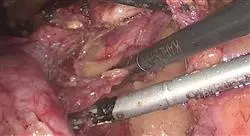especializacion nuevas técnicas de cirugía mínimamente invasiva y robótica en ginecología