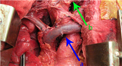 cursos carcinoma pulmonar tumores de la pleura mediastino y pared torácica