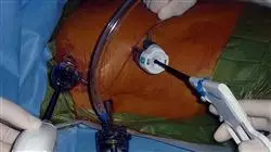 especializacion online carcinoma pulmonar tumores pleura mediastino pared toracica