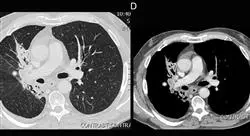 formacion oncología traslacional en oncología torácica