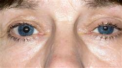 diplomado acreditado pupila nervio optico caja