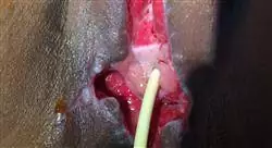 cursos cáncer de vulva