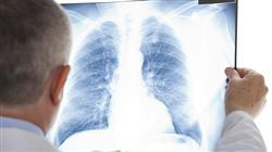 curso online trasplante pulmonar