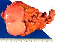 diplomado online tumores corteza adrenal