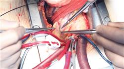 cursos cirugia coronaria