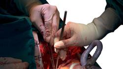 especializacion online cirugia coronaria
