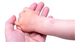 formacion dermatitis atopica infantil