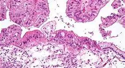 curso epidemiología y diagnóstico del cáncer de ovario