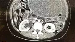 diplomado diagnostico cancer ovario