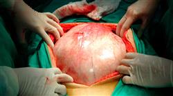 formacion tratamiento manejo cancer ovario