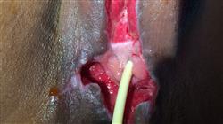 posgrado epidemiologia diagnostico cancer vulva