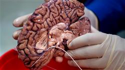experto universitario oncologia medica pulmonar orl cerebral