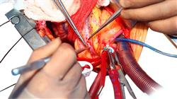 diplomado terapias revascularizacion sindrome coronario agudo