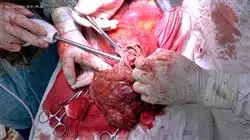 curso online patologia quirurgica suprarrenal retroperitoneo