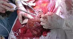 curso patología quirúrgica suprarrenal y del retroperitoneo