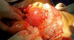 diplomado patología quirúrgica suprarrenal y del retroperitoneo