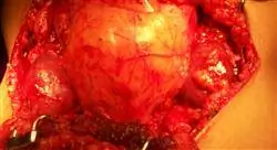 diplomado online patología quirúrgica renal