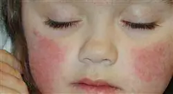 diplomado online alergias reumatología y nefrourología en pediatría