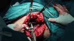 curso tumores ginecológicos infrecuentes