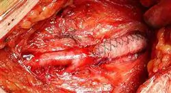 diplomado online cirugía vascular renal