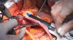 curso patología quirúrgica del tracto urinario superior
