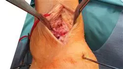 cursos injerto quirurgico pie tobillo