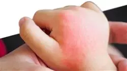 cursos valoracion alergia alimentaria medicamentosa infantil