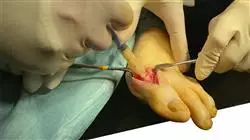 curso online cirugia antepie patologias dedos trifalangicos metatarsos