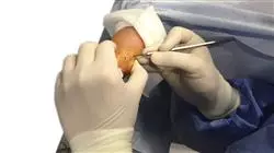 diplomado cirugia antepie patologias dedos trifalangicos metatarsos