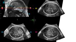 estudiar diagnostico genetico fetal procedimientos invasivos