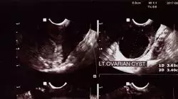 especializacion online tratamiento radioterapico tumores ginecologicos urologicos