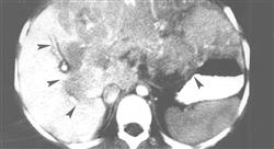 diplomado online tratamiento radioterápico de tumores digestivos