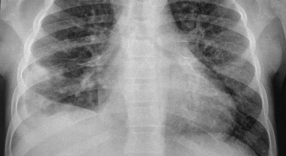 formacion cardiopatías miocardiopatías y tumores en la edad pediátrica