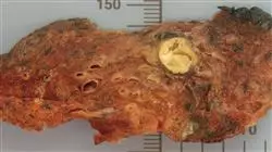 master online actualizacion patologia oncologica patologos