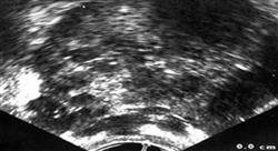 diplomado tumores genito urinarios